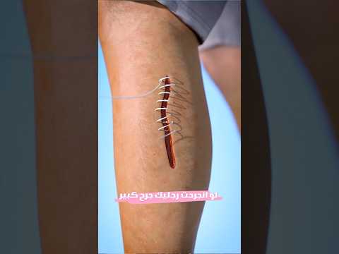 لو انجرحت رجليك جرح كبير