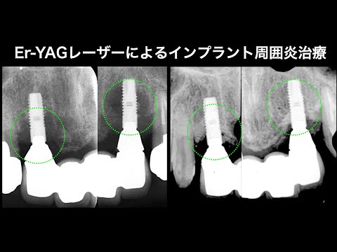 Er YAG（エルビウムヤグ）レーザーを使用したインプラント周囲炎
