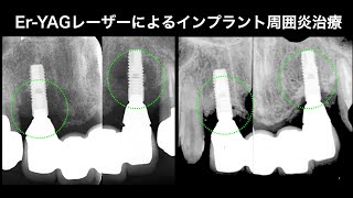 クインテッセンス インプラント周囲円はEr:YAG Laserでこう治す！ エキスパートが初めて明かす技のバイブル！ インプラント周囲炎