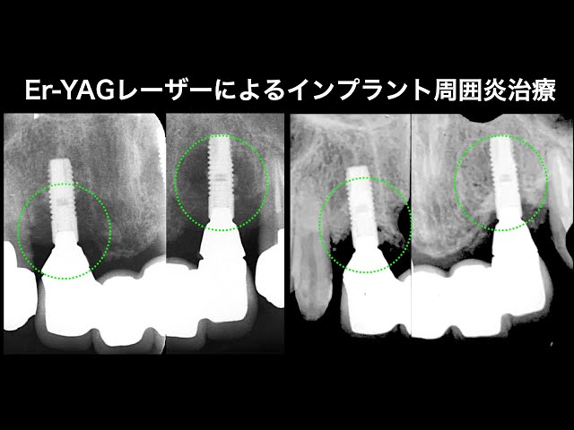 クインテッセンス インプラント周囲円はEr:YAG Laserでこう治す