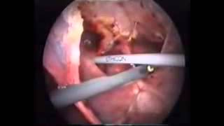 HERNIA DE MORGAGNI. A PROPÓSITO DE TRES CASOS