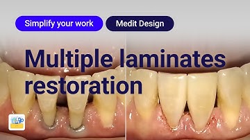 Simplify Your Work - Multiple Laminates Restoration