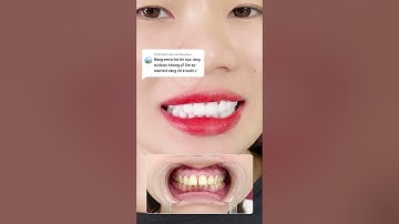 BỌC RĂNG SỨ CẢI THIỆN TÌNH TRẠNG HÔ