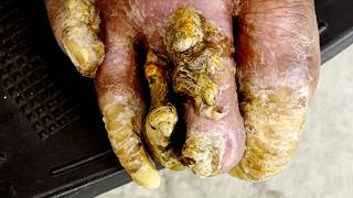The Onychomycosis And Dead Skin Are Stuck Together, So Separate Them Carefully!【Xue Yidao】
