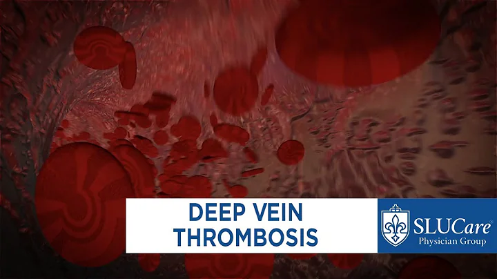 Treating Deep Vein Thrombosis - SLUCare Vascular Surgery - DayDayNews