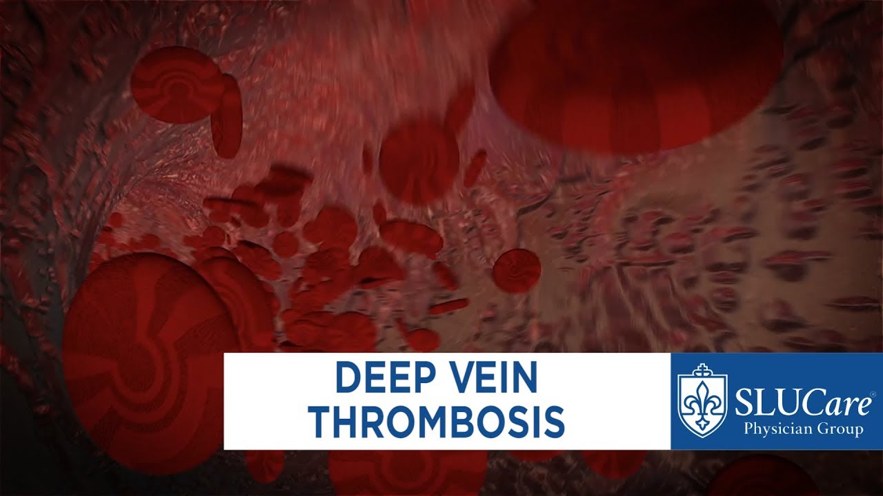 thrombophlebitis visszérrel mit kell tenni)