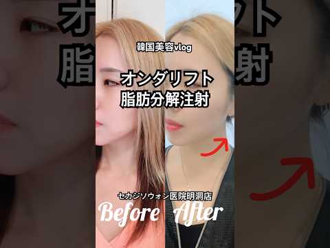 オンダ 脂肪溶解