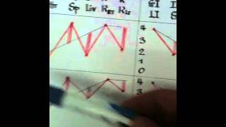 Acupuncture pulse diagnosis with pulse map 5