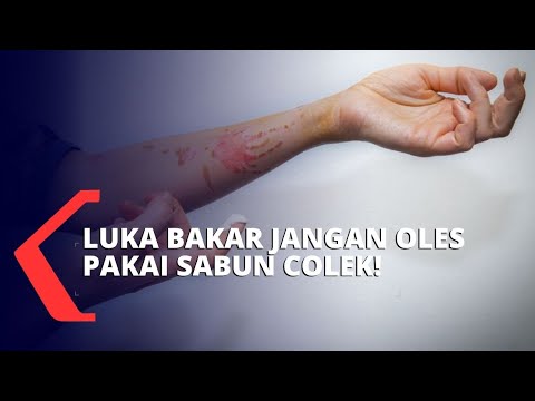 Video: Pertolongan Pertama Untuk Luka Bakar Dieffenbachia