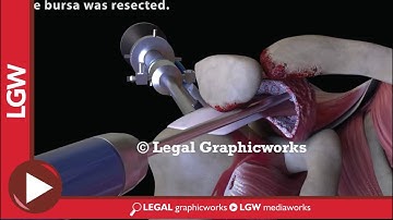 Shoulder Replacement Surgery 3D Animation