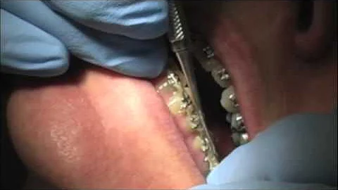 Transition from T-Loop to 018 SS Finishing Wire (Part 1)