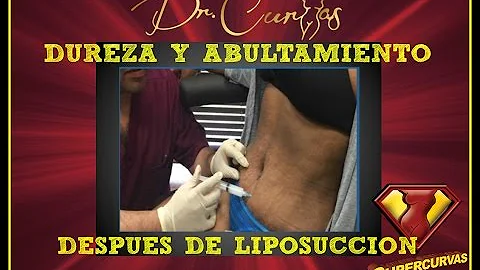 ¿Por qué mi estómago parece más grande después de una liposucción?