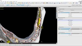 Closing Reduced Bone Model