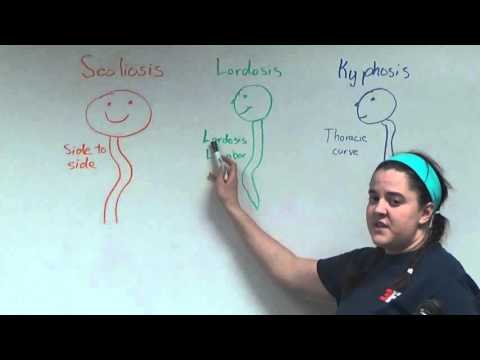 Scoliosis, Lordosis, and Kyphosis