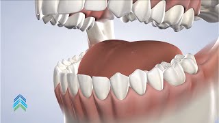 Instructions Following Biopsy/Laser Surgery at Avon Oral, Facial and Dental Implant Surgery