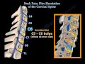 Neck Pain, Disc Herniation Of The Cervical Spine - Everything You Need To Know - Dr. Nabil Ebraheim