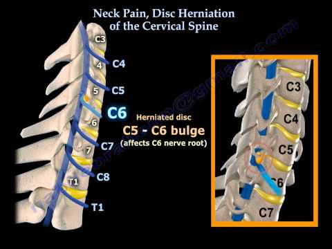 Neck Pain, Disc Herniation Of The Cervical Spine - Everything You Need To Know - Dr. Nabil Ebraheim