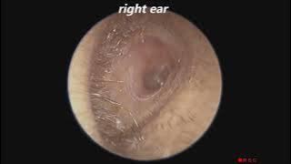 The Normal Ear Passage and Eardrum