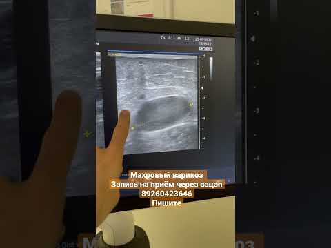 Варикоз на ноге. Узи сосудов. Лечение варикоза. Сосудистый хирург Москва. Флеболог. Флеболог Москва