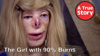 The Girl With 90% Burns: The FULL Documentary | A True Story