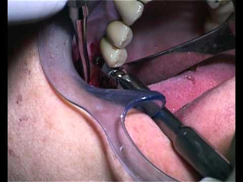 iraise-sinus-lift-implant-clinical-procedure-january-2012
