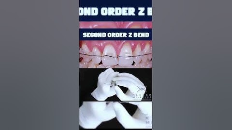 SECOND ORDER Z BEND - ORTHODONTIC TIPS #Shorts