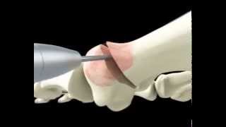 видео Ортопедические стельки при вальгусной деформации большого пальца у детей и взрослых, отзывы