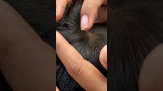 Head lice removal from hair getting out all hundred lice from head