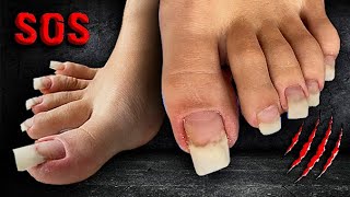 I have NOT cut my toenails for a year.😱 Ingrown NAIL. Hurts! What to do? Mistakes in pedicure.