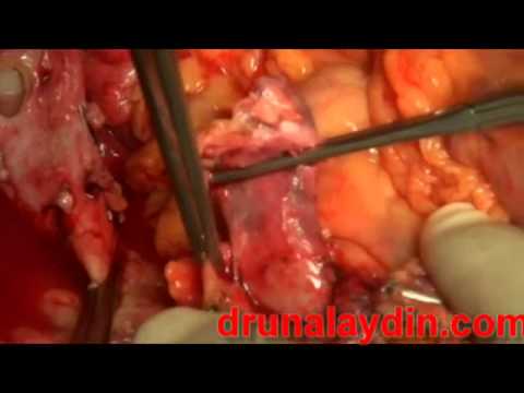 Technique of Portal Vein Thrombectomy in Liver Transplant by drunalaydin