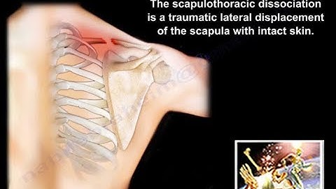 Scapulothoracic Dissociation - Everything You Need To Know - Dr. Nabil Ebraheim