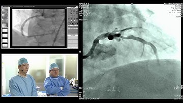 [TCTAP 2017] Coronary Symposium - Live Case & Lecture Session IV