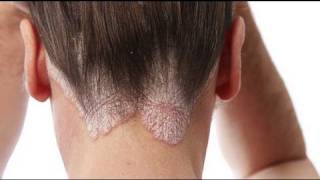 Psoriasis en los niños, enfermedad de la piel