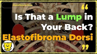 Is That A Lump In Your Back? Understanding Elastofibroma Dorsi