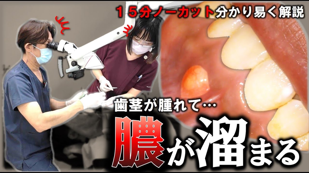 『歯ぐきが腫れて 膿が溜まる…』治療 15分ノーカット　  #根管治療