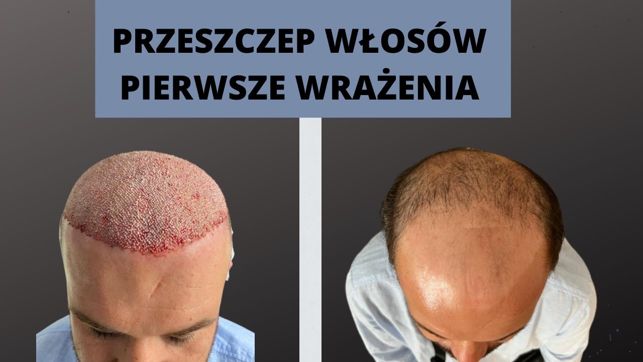 Przeszczep włosów w Turcji - pierwsze wrażenia. - YouTube