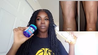 Say Goodbye To Varicose Veins With Vaporub And Lavender Oil
