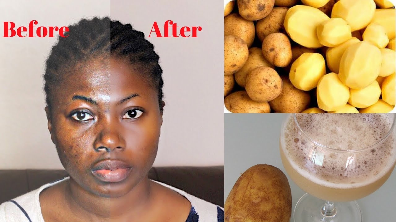 Dark Spots On Black Skin Naturally Dark Spots On Black Skin Naturally