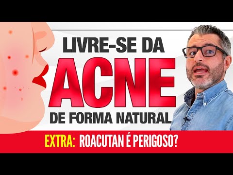 ACNE: como tratar as espinhas naturalmente 👉 🔴 👈