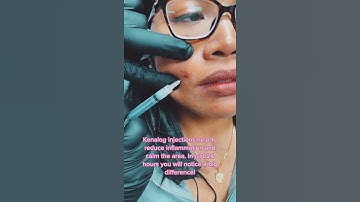 Cure to Cystic Acne FOUND 👁