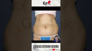 두껍아 두껍아 옆구리 지방 가져가고 잘록한 허리라인 다오!! #지방흡입부작용 #복부지방흡입 #옆구리살빼기