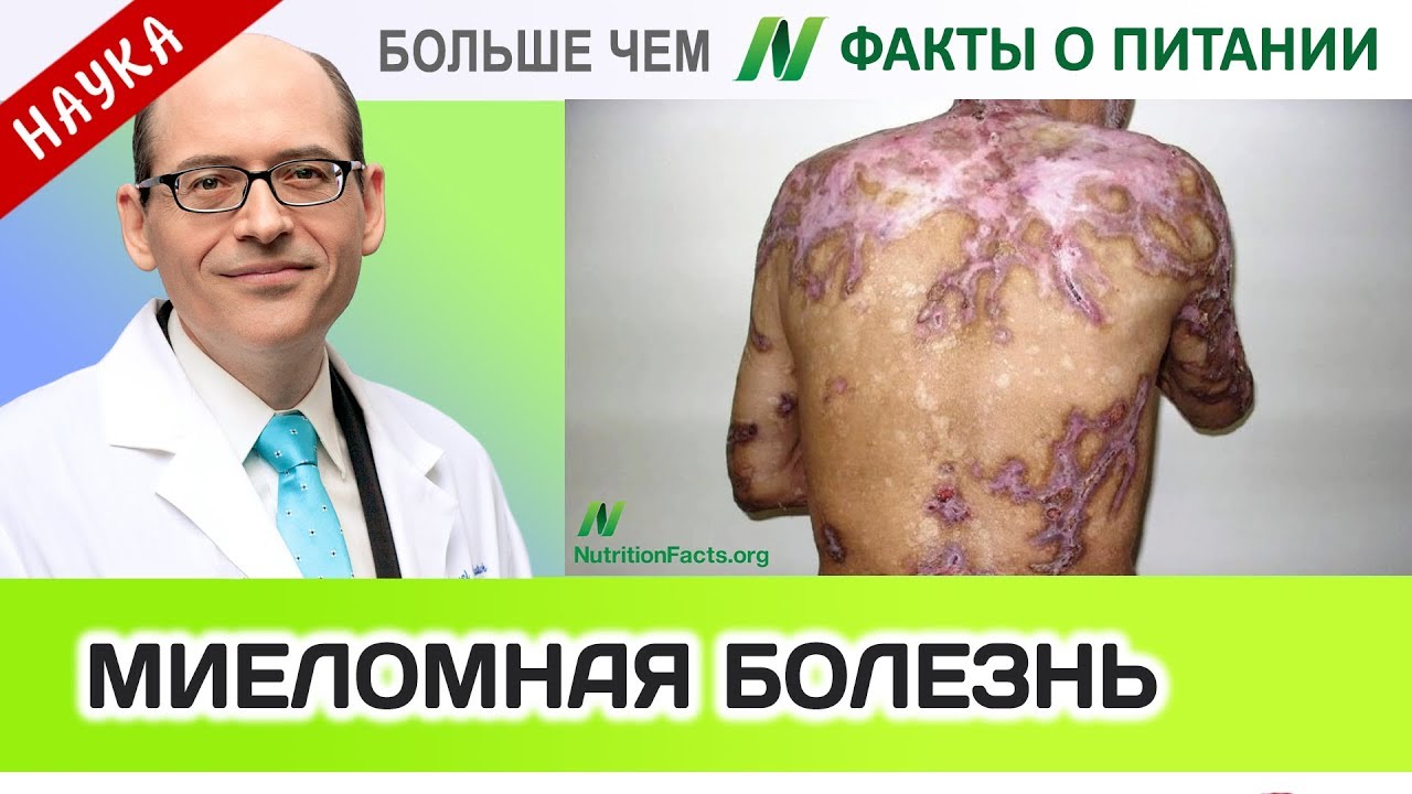 1019.Куркумин куркумы, МГНЗ и миеломная болезнь | Больше чем ФАКТЫ О ПИТАНИИ - Майкл Грегер