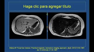 Lesiones Focales del Hígado: abordaje por resonancia magnética