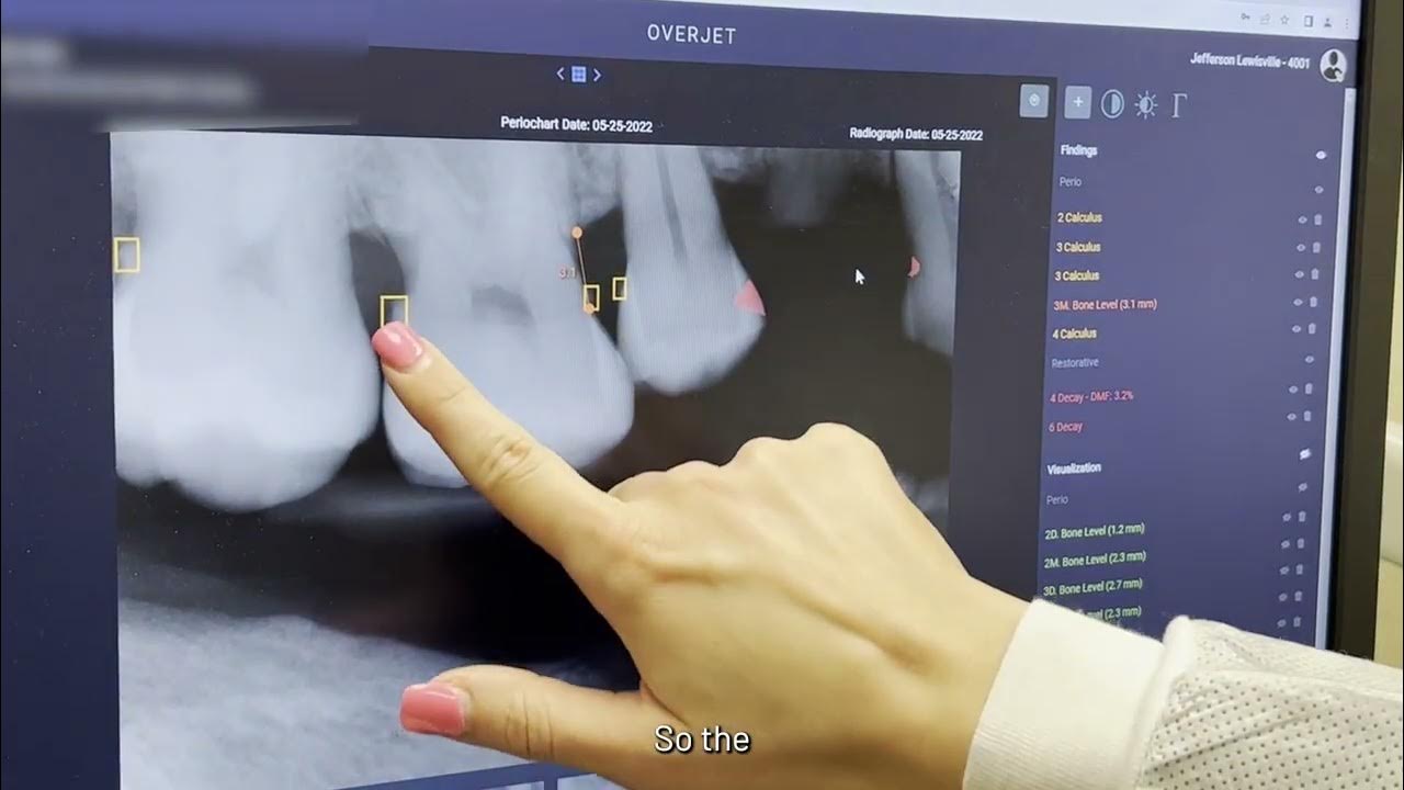 Using Overjet (AI) to Improve Our Patient Experience YouTube
