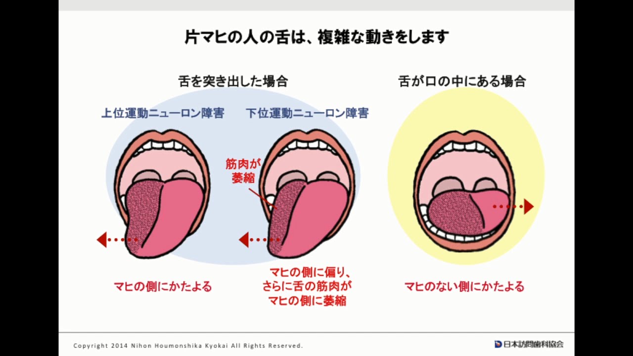 舌 の 偏 位 と は