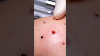 “Relax, Watch, Sleep 😴 Deep Pore Vacuum Blackhead Removal”