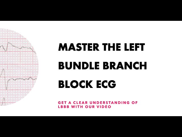 Master the Left Bundle Branch Block ECG: Get a clear understanding of LBBB with our video.