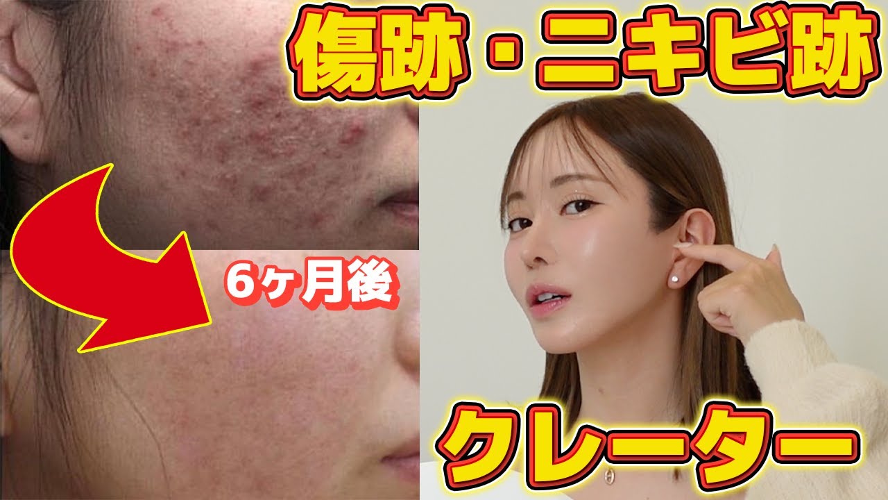 ニキビ跡、クレーター、整形の傷跡などに悩んでいる人は見て