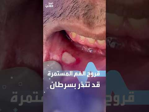 قروح الفم المستمرة قد تنذر بسرطان