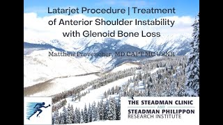 Latarjet Procedure | Treatment of Anterior Shoulder Instability with Glenoid Bone Loss